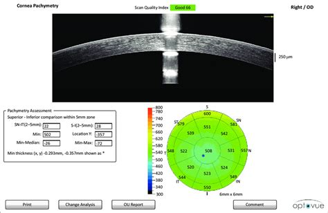 instrument measure thickness of cornea|corneal thickness pachy chart.